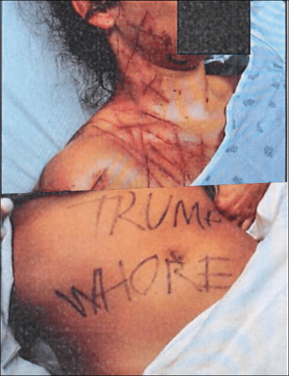 Photo from federal court filing shows scalpel cuts and marker writing on body including "Trump whore" used as fabricated evidence in staged political attack