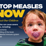 South Carolina Department of Public Health "Stop Measles Now" poster showing a young child with a measles rash on the face and arms